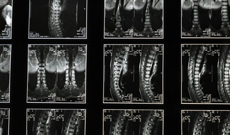 spinal images